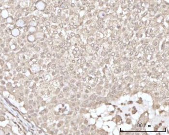 IHC staining of FFPE human lung cancer tissue with Recoverin antibody. HIER: boil tissue sections in pH8 EDTA for 20 min and allow to cool before testing.