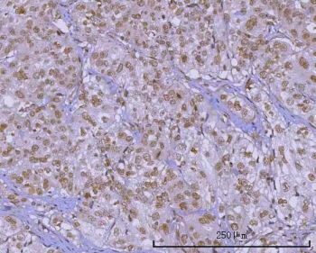 IHC staining of FFPE human urothelial carcinoma tissue with PRPF18 antibody. HIER: boil tissue sections in pH8 EDTA for 20 min and allow to cool before testing.