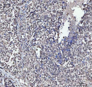 IHC staining of FFPE human poorly differentiated adenocarcinoma of the ovary with PLEKHG5 antibody. HIER: boil tissue sections in pH8 EDTA for 20 min and allow to cool before testing.