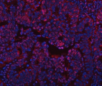 Immunofluorescent staining of FFPE human intestinal cancer tissue with Protein phosphatase 1G antibody (red) and DAPI nuclear stain (blue). HIER: steam section in pH8 EDTA buffer for 20 min.