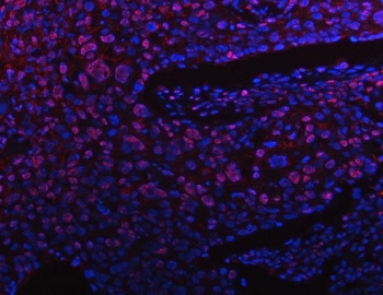 Immunofluorescent staining of FFPE human esophagus squama cancer tissue with Protein phosphatase 1G antibody (red) and DAPI nuclear stain (blue). HIER: steam section in pH8 EDTA buffer for 20 min.