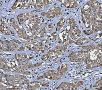 IHC staining of FFPE human lymphoma tissue with Protein phosphatase 1G antibody. HIER: boil tissue sections in pH8 EDTA for 20 min and allow to cool before testing.