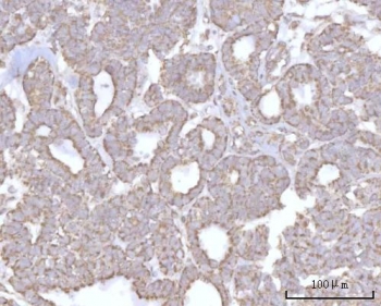IHC staining of FFPE human ovary serous carcinoma tissue with PRDM15 antibody. HIER: boil tissue sections in pH8 EDTA for 20 min and allow to cool before testing.