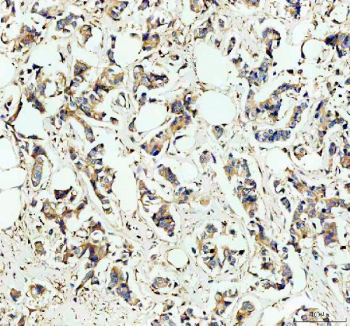 IHC staining of FFPE human breast cancer tissue with HGPRTase antibody, HRP-secondary and DAB substrate. HIER: boil tissue sections in pH8 EDTA for 20 min and allow to cool before testing.