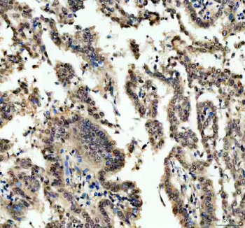 IHC staining of FFPE human lung cancer tissue with OTT1 antibody. HIER: boil tissue sections in pH8 EDTA for 20 min and allow to cool before testing.