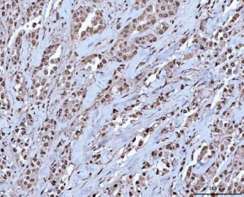 IHC staining of FFPE human breast cancer tissue with OTT1 antibody. HIER: boil tissue sections in pH8 EDTA for 20 min and allow to cool before testing.