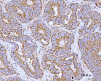 IHC staining of FFPE human rectum adenocarcinoma tissue with HRPAP20 antibody. HIER: boil tissue sections in pH8 EDTA for 20 min and allow to cool before testing.