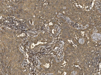 IHC staining of FFPE human lung cancer tissue with Eukaryotic translation initiation factor 5 antibody. HIER: boil tissue sections in pH8 EDTA for 20 min and allow to cool before testing.
