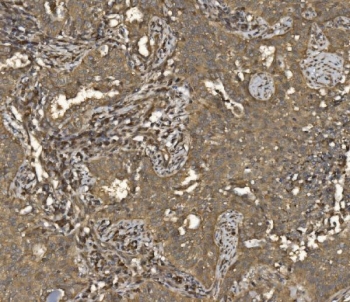 IHC staining of FFPE human lung cancer tissue with Eukaryotic translation initiation factor 5 antibody. HIER: boil tissue sections in pH8 EDTA for 20 min and allow to cool before testing.