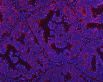 Immunofluorescent staining of FFPE human intestinal cancer with PGP antibody (red) and DAPI nuclear stain (blue). HIER: steam section in pH8 EDTA buffer for 20 min.