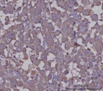 IHC staining of FFPE human lung adenocarcinoma tissue with Serpin A8 antibody. HIER: boil tissue sections in pH8 EDTA for 20 min and allow to cool before testing.