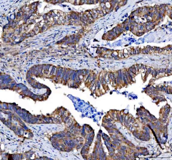 IHC staining of FFPE human colon cancer tissue with Ephrin Receptor B3 antibody, HRP-secondary and DAB substrate. HIER: boil tissue sections in pH8 EDTA for 20 min and allow to cool before testing.