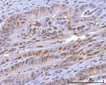 IHC staining of FFPE human rectum adenocarcinoma tissue with HOXD10 antibody. HIER: boil tissue sections in pH8 EDTA for 20 min and allow to cool before testing.