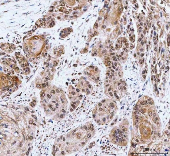 IHC staining of FFPE human esophageal squamous carcinoma tissue with CBP80 antibody. HIER: boil tissue sections in pH8 EDTA for 20 min and allow to cool before testing.