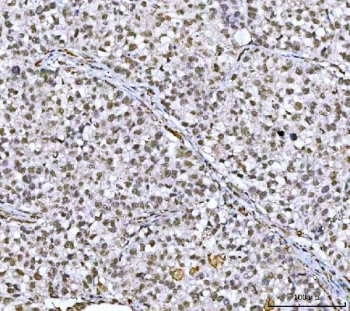 IHC staining of FFPE human lung cancer tissue with CBP80 antibody. HIER: boil tissue sections in pH8 EDTA for 20 min and allow to cool before testing.