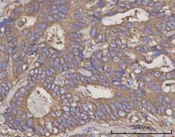 IHC staining of FFPE human rectum adenocarcinoma tissue with NDUFA4 antibody. HIER: boil tissue sections in pH8 EDTA for 20 min and allow to cool before testing.