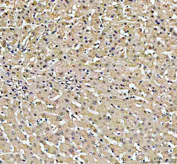 PSMB2 Antibody Human Liver Cancer IHC. Immunohistochemical staining of FFPE human liver cancer tissue with PSMB2 antibody at 2 ug/ml. Heat-induced epitope retrieval (HIER) was performed by boiling tissue sections in pH 8 EDTA buffer prior to staining. PSMB2 immunoreactivity is observed predominantly within the cytoplasm of malignant hepatocytes, consistent with the expected localization of this proteasome core subunit that participates in ubiquitin-mediated protein degradation, protein quality control, and maintenance of cellular proteostasis. Cell nuclei are counterstained with hematoxylin (blue).