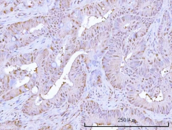 IHC staining of FFPE human rectum adenocarcinoma tissue with Proteasome subunit beta type 9 antibody. HIER: boil tissue sections in pH8 EDTA for 20 min and allow to cool before testing.
