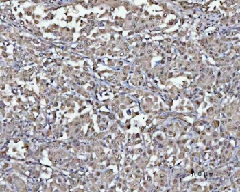 IHC staining of FFPE human lung cancer tissue with PSMD4 antibody. HIER: boil tissue sections in pH8 EDTA for 20 min and allow to cool before testing.