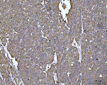 IHC staining of FFPE human ovarian cancer tissue with PYCR1 antibody. HIER: boil tissue sections in pH8 EDTA for 20 min and allow to cool before testing.