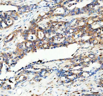 IHC staining of FFPE human pancreas cancer tissue with PYGL antibody. HIER: boil tissue sections in pH8 EDTA for 20 min and allow to cool before testing.