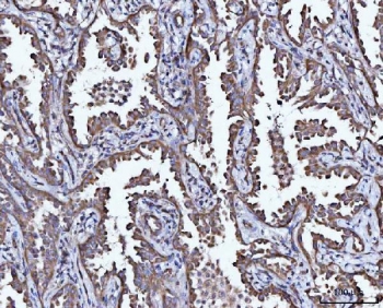 IHC staining of FFPE human lung cancer tissue with MIP-5 antibody. HIER: boil tissue sections in pH8 EDTA for 20 min and allow to cool before testing.
