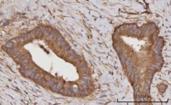 IHC staining of FFPE human rectum adenocarcinoma tissue with C-C motif chemokine 23 antibody. HIER: boil tissue sections in pH8 EDTA for 20 min and allow to cool before testing.