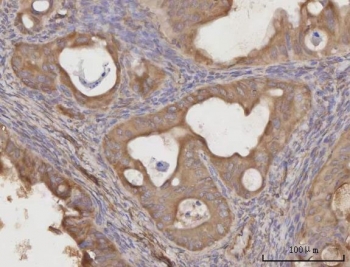 IHC staining of FFPE human thyroid papillary carcinoma tissue with C-C motif chemokine 23 antibody. HIER: boil tissue sections in pH8 EDTA for 20 min and allow to cool before testing.