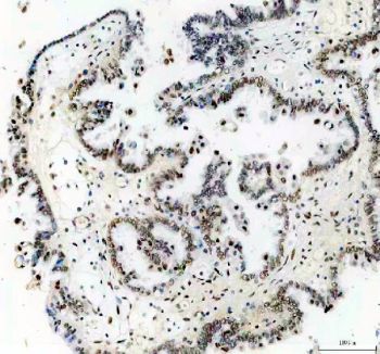 IHC staining of FFPE human ovarian cancer tissue with TP53BP1 antibody, HRP-secondary and DAB substrate. HIER: boil tissue sections in pH8 EDTA for 20 min and allow to cool before testing.
