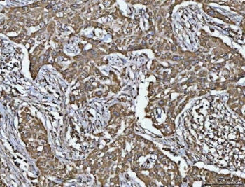IHC staining of FFPE human lymphadenoma tissue with VDAC1 antibody. HIER: boil tissue sections in pH8 EDTA for 20 min and allow to cool before testing.