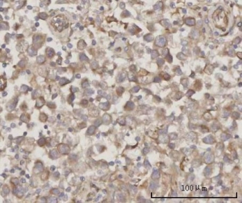 IHC staining of FFPE human testicular seminoma tissue with PRDM2 antibody. HIER: boil tissue sections in pH8 EDTA for 20 min and allow to cool before testing.