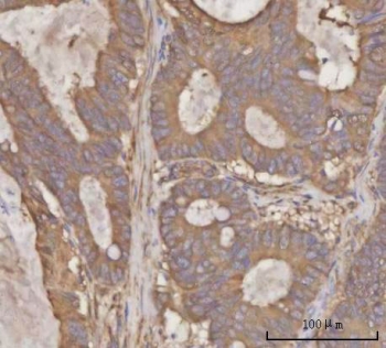 IHC staining of FFPE human rectum adenocarcinoma tissue with PRDM2 antibody. HIER: boil tissue sections in pH8 EDTA for 20 min and allow to cool before testing.