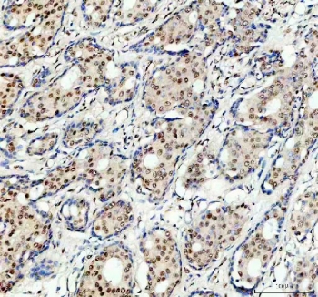 IHC staining of FFPE human breast cancer tissue with PRPF4 antibody. HIER: boil tissue sections in pH8 EDTA for 20 min and allow to cool before testing.