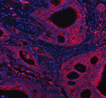 Immunofluorescent staining of FFPE human intestinal cancer tissue with PPM1F antibody (red) and DAPI nuclear stain (blue). HIER: steam section in pH8 EDTA buffer for 20 min.