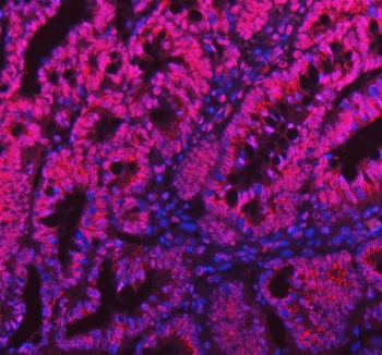 Immunofluorescent staining of FFPE human intestinal cancer tissue with SAM68 antibody (red) and DAPI nuclear stain (blue). HIER: steam section in pH8 EDTA buffer for 20 min.