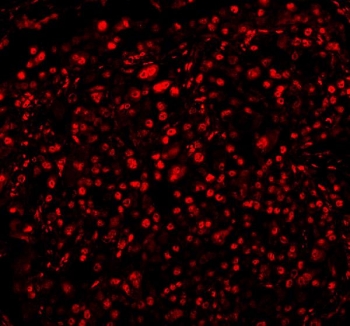Immunofluorescent staining of FFPE human lung cancer tissue with RBFOX2 antibody (red). HIER: steam section in pH8 EDTA buffer for 20 min.