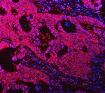 PYCARD Antibody / Inflammasome Adaptor Protein Antibody Human Intestinal Cancer IF. Immunofluorescent staining of FFPE human intestinal cancer tissue using PYCARD Antibody / Inflammasome Adaptor Protein Antibody (red) with DAPI nuclear counterstain (blue). PYCARD expression is observed predominantly within the cytoplasm of tumor cells, consistent with its role as an adaptor protein that mediates inflammasome assembly, innate immune signaling, and inflammatory responses. Heat-induced epitope retrieval was performed by steaming sections in pH 8 EDTA buffer for 20 minutes prior to immunofluorescent staining.
