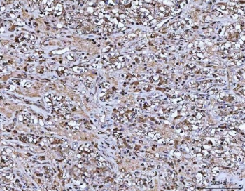 PYCARD Antibody / Inflammasome Adaptor Protein Antibody Human Glioblastoma IHC. Immunohistochemical staining of FFPE human glioblastoma tissue using PYCARD Antibody / Inflammasome Adaptor Protein Antibody. PYCARD expression is detected predominantly within the cytoplasm of tumor cells, consistent with its role as a central adaptor protein in inflammasome assembly and innate immune signaling. Heat-induced epitope retrieval was performed by boiling tissue sections in pH 8 EDTA buffer for 20 minutes and allowing them to cool prior to immunostaining.