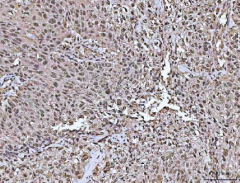 PYCARD Antibody / Inflammasome Adaptor Protein Antibody Human Urothelial Carcinoma IHC. Immunohistochemical staining of FFPE human urothelial carcinoma with squamous differentiation using PYCARD Antibody / Inflammasome Adaptor Protein Antibody. PYCARD expression is observed predominantly within the cytoplasm of neoplastic cells, consistent with its established role as an inflammasome adaptor protein involved in innate immune signaling, inflammatory responses, and pyroptotic cell death. Heat-induced epitope retrieval was performed by boiling tissue sections in pH 8 EDTA buffer for 20 minutes and allowing them to cool prior to immunostaining.