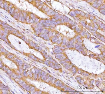 IHC staining of FFPE human rectum adenocarcinoma tissue with TRNT1 antibody. HIER: boil tissue sections in pH8 EDTA for 20 min and allow to cool before testing.