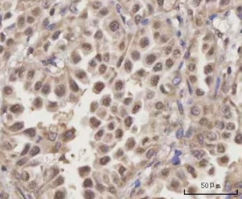 IHC staining of FFPE human lung adenocarcinoma tissue with Selenocysteine lyase antibody. HIER: boil tissue sections in pH8 EDTA for 20 min and allow to cool before testing.