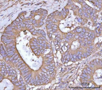 IHC staining of FFPE human rectum adenocarcinoma tissue with NANP antibody. HIER: boil tissue sections in pH8 EDTA for 20 min and allow to cool before testing.
