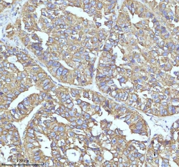 IHC staining of FFPE human liver cancer tissue with Clathrin heavy chain antibody. HIER: boil tissue sections in pH8 EDTA for 20 min and allow to cool before testing.
