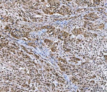IHC staining of FFPE human esophageal squamous carcinoma tissue with GLI2 antibody. HIER: boil tissue sections in pH8 EDTA for 20 min and allow to cool before testing.