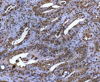 NR5A2 Antibody Colorectal Cancer IHC. Immunohistochemistry staining of FFPE human colorectal adenocarcinoma tissue using NR5A2 antibody demonstrates prominent nuclear and cytoplasmic HRP-DAB brown staining within malignant gland-forming epithelial cells and infiltrative tumor-associated structures. The observed staining profile is consistent with expression of NR5A2 / Liver receptor homolog 1, a nuclear receptor transcription factor involved in epithelial metabolic signaling and developmental regulatory pathways. HIER: boil tissue sections in pH8 EDTA for 20 min and allow to cool before testing.