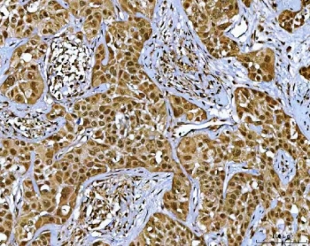 NR5A2 Antibody Parotid Carcinoma IHC. Immunohistochemistry staining of FFPE human parotid acinar cell carcinoma tissue using NR5A2 antibody demonstrates diffuse nuclear-associated and cytoplasmic HRP-DAB brown staining throughout malignant epithelial nests and acinar-like tumor compartments. The staining pattern supports localization of NR5A2 / Liver receptor homolog 1 within metabolically active epithelial-derived carcinoma cells linked to transcriptional regulation and endocrine-associated signaling pathways. HIER: boil tissue sections in pH8 EDTA for 20 min and allow to cool before testing.