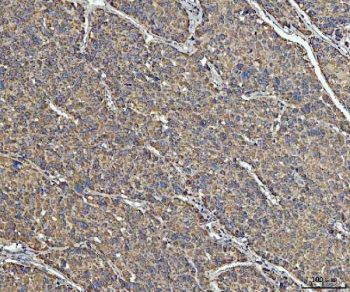 IHC staining of FFPE human liver cancer tissue with Acetyl-CoA acetyltransferase antibody. HIER: boil tissue sections in pH8 EDTA for 20 min and allow to cool before testing.