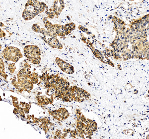 Nucleoporin 107 Antibody in Human Liver Cancer IHC. Immunohistochemistry analysis of FFPE human liver cancer tissue with Nucleoporin 107 Antibody / Nuclear Pore Complex Antibody at 2 ug/ml. Heat-induced epitope retrieval (HIER) was performed in EDTA buffer, pH 8.0, followed by blocking with 10% goat serum. The tissue was incubated with the primary antibody overnight at 4oC, followed by a peroxidase-conjugated goat anti-rabbit IgG secondary antibody for 30 min at 37oC and DAB detection. NUP107 staining is observed in the tumor cells. This Nucleoporin 107 Antibody demonstrates detection of NUP107 in human liver cancer tissue.