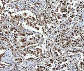 IHC staining of FFPE human lung cancer tissue with NSUN2 antibody. HIER: boil tissue sections in pH8 EDTA for 20 min and allow to cool before testing.