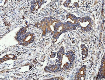 MMP19 Antibody Human Colorectal Adenocarcinoma IHC. Immunohistochemistry staining of FFPE human colorectal adenocarcinoma tissue using MMP19 antibody demonstrates strong cytoplasmic and membranous staining within malignant gland-forming epithelial cells, consistent with expression of Matrix Metalloproteinase 19 (MMP19). MMP19 is a tissue remodeling protein that regulates extracellular matrix turnover, cellular migration, and interactions between tumor cells and the surrounding microenvironment. The observed staining pattern is consistent with the established role of matrix metalloproteinases in extracellular matrix remodeling and tissue reorganization. These findings support the utility of MMP19 antibody for studies of tissue remodeling, extracellular matrix regulation, and tumor-associated cellular behavior. HIER: boil tissue sections in pH8 EDTA for 20 min and allow to cool before testing.
